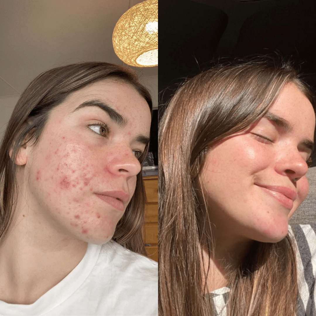 Before after results of Glory Oil on acne inflamed red skin