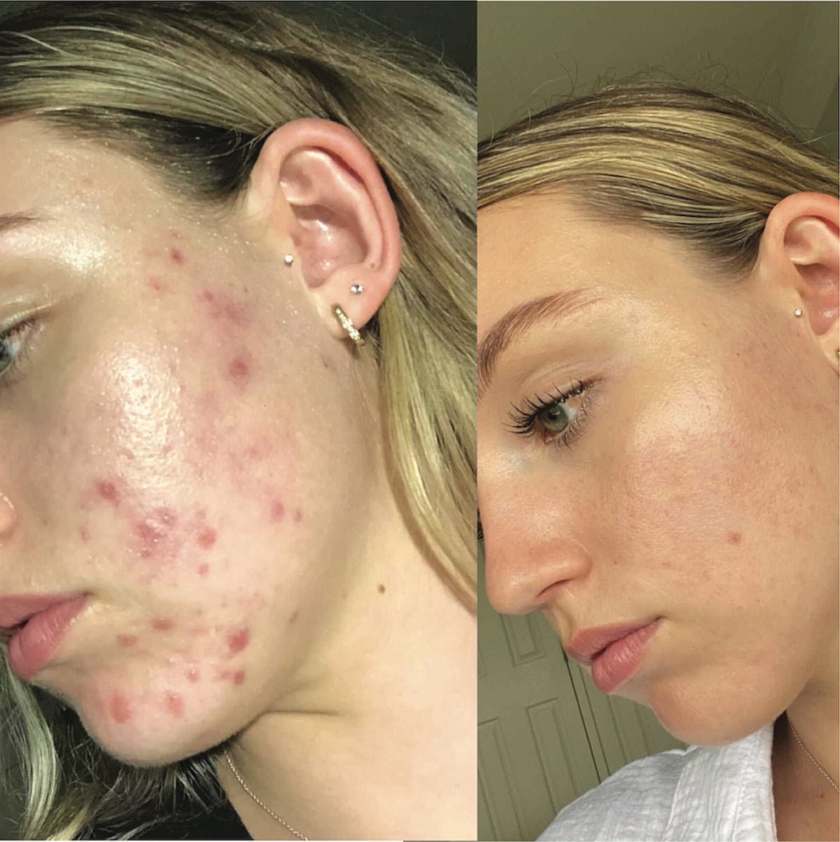 Clear Skin System before after results on acne pimples skin texture